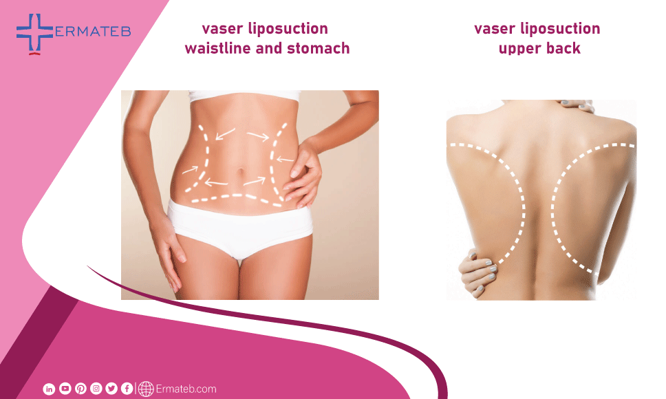 vaser liposuction of waistline, stomach and upper back